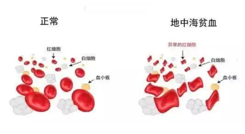 什么是地中海贫血