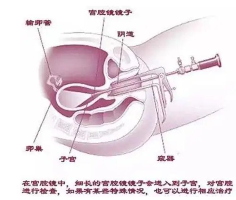 宫腔镜怎么做检查