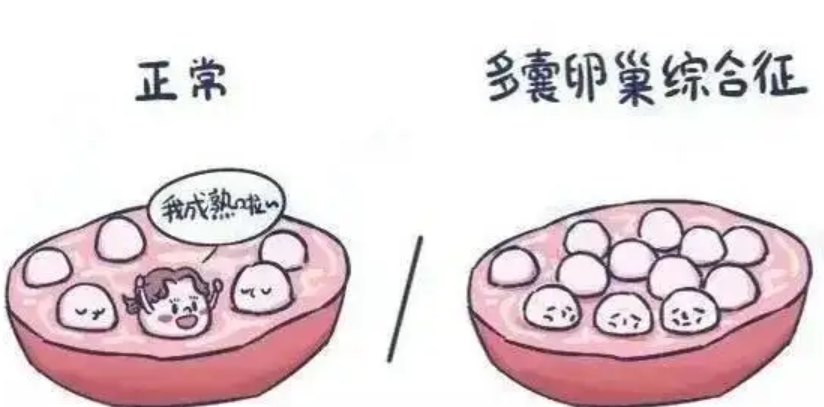 多囊想怀孕怀不上教你三招,6个方法提高受孕率