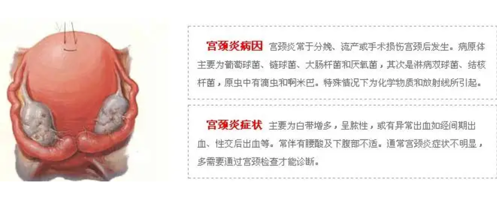 什么是宫颈炎导致不孕