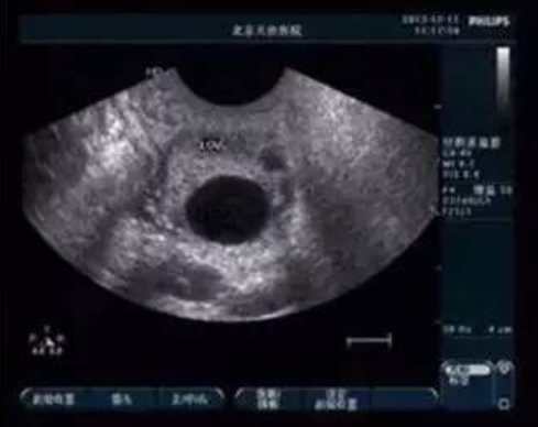 卵泡成熟后不破裂是怎么回事？