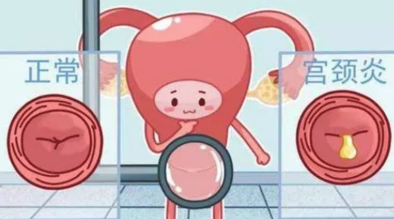 什么是宫颈性不孕
