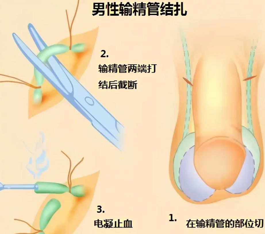 男性结扎之后还能够进行试管婴儿手术吗？