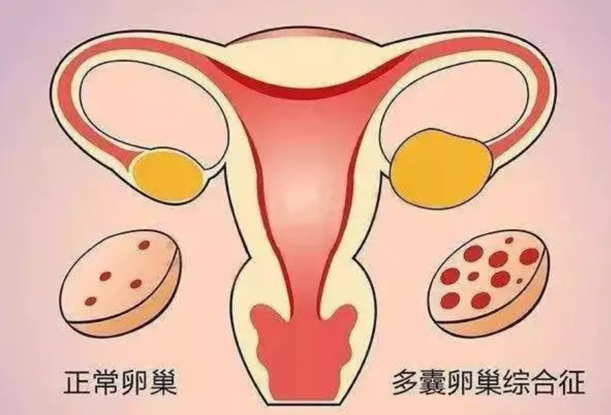 什么是卵巢发育异常