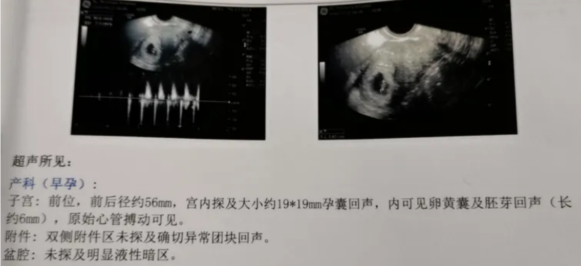 试管移植有胎心胎芽是不是就安全了