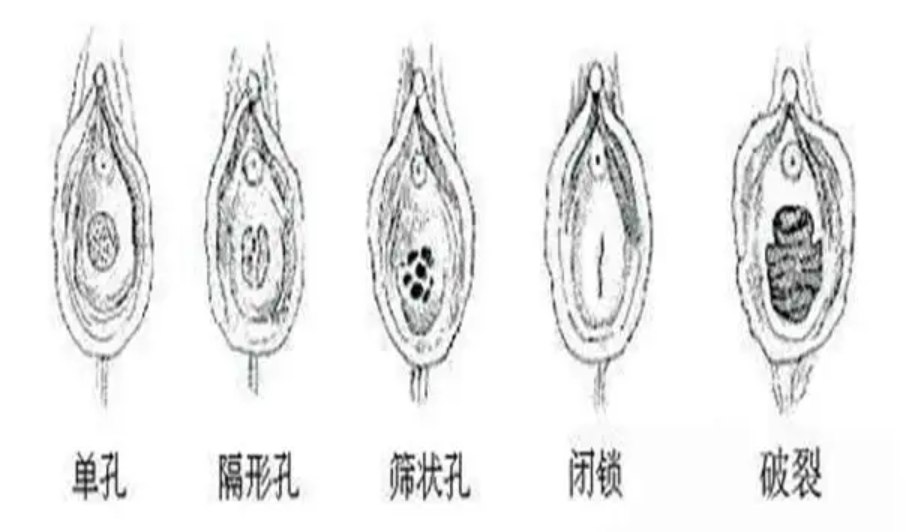 什么是处女膜闭锁