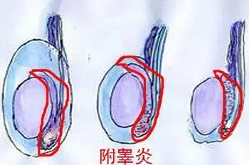 什么是附睾炎