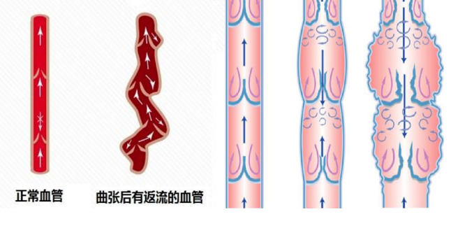 “蛋疼”的忧伤：精索静脉曲张，是怎么一回事？