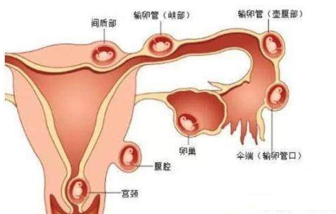 宫外孕不得已手术，婆婆第一句话还能生么，我想抱孙子 
