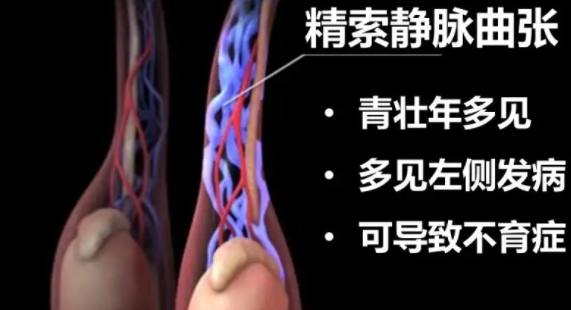 什么是精索静脉曲张