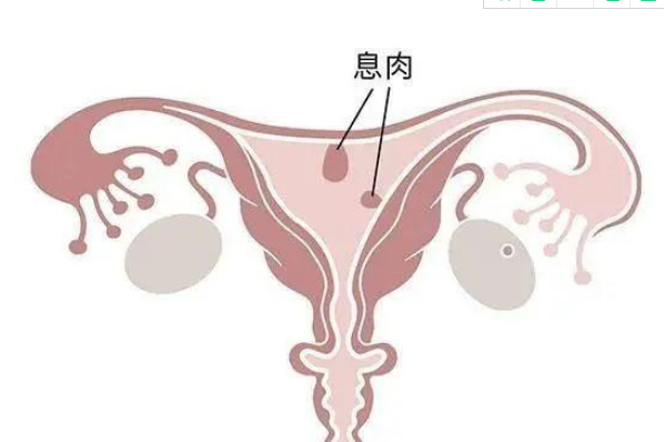 什么人容易得子宫内膜息肉？