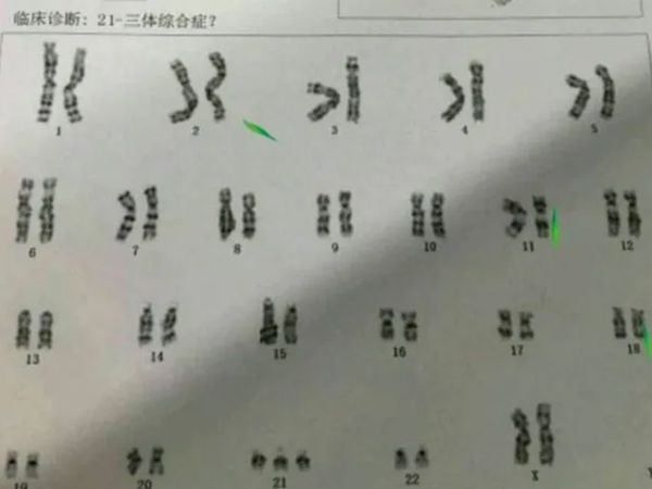 21三体先天愚型可以做三代试管实现生育吗？