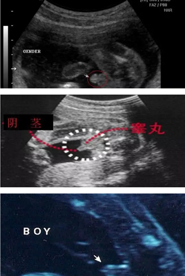 怀孕11-13周时男宝jj形状是什么样的呢