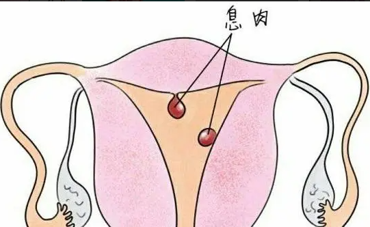 子宫内膜息肉拖久了会怎么样 子宫内膜息肉可以分为两种