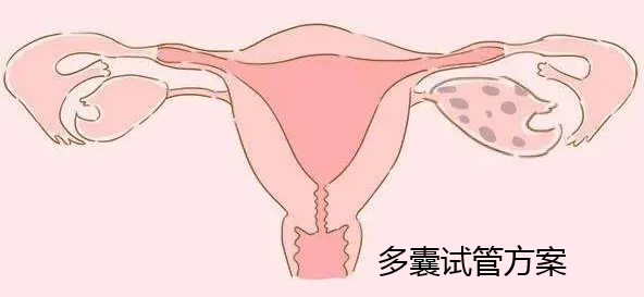 多囊试管方案有哪些用什么方案好