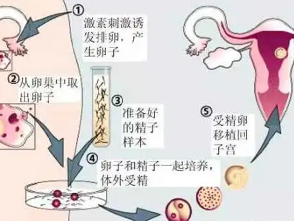 济宁医学院附属医院供精试管婴儿流程图是怎么样的？