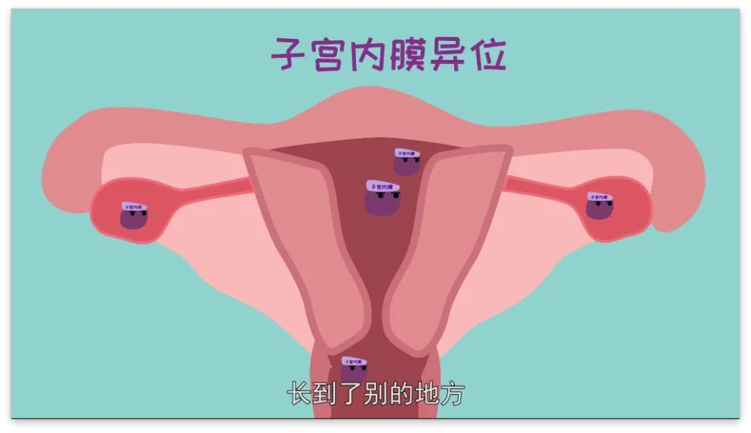 “不死的癌症”——子宫内膜异位症详解