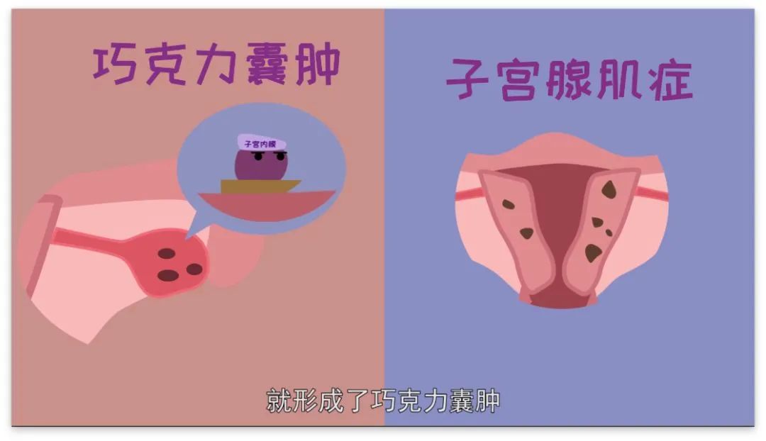 “不死的癌症”——子宫内膜异位症详解
