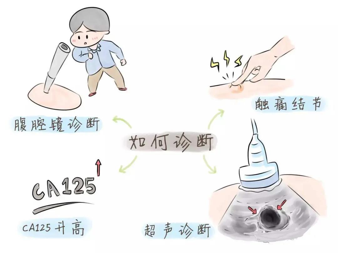 “不死的癌症”——子宫内膜异位症详解