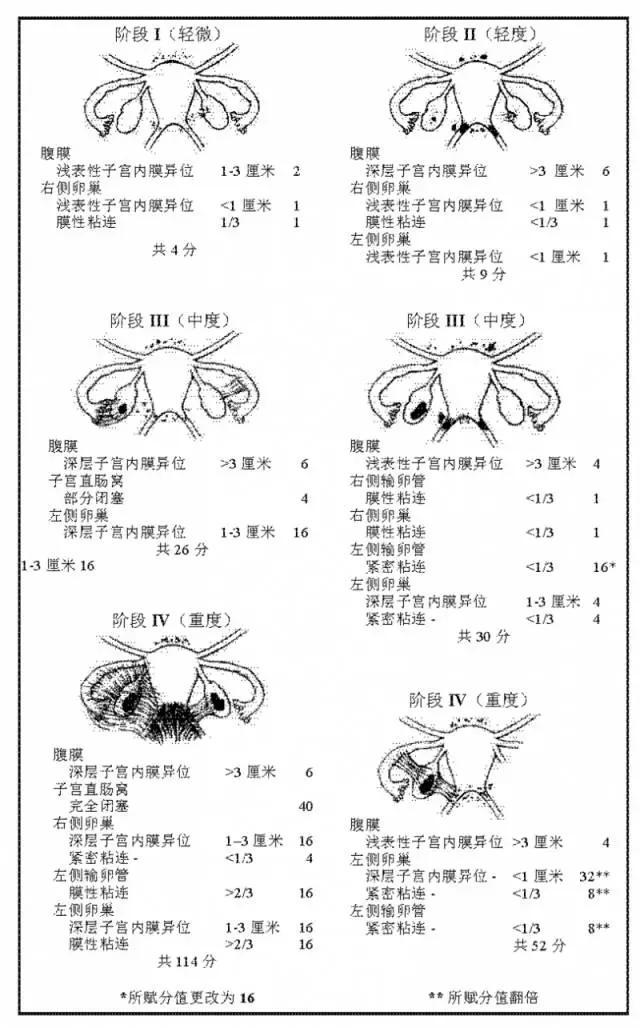 “不死的癌症”——子宫内膜异位症详解