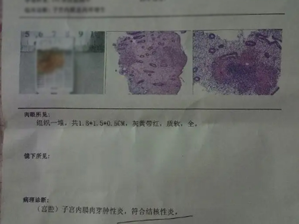 生殖结核治愈后做试管的成概率有多少？