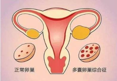 99%的多囊患者都曾经疑惑过这些问题,看看你遇上了么?