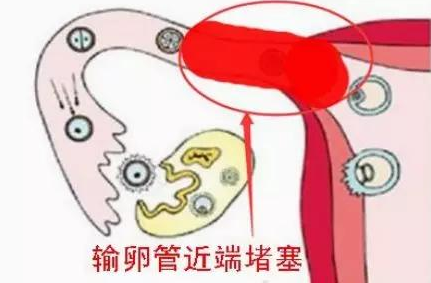 女性不孕或是这9个原因导致,身体这几个信号提示要格外注意