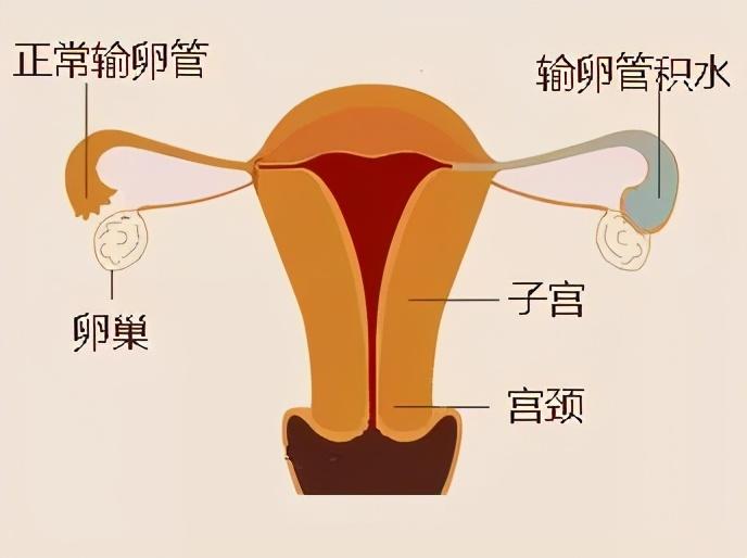 输卵管有积水,是疏通还是切除?