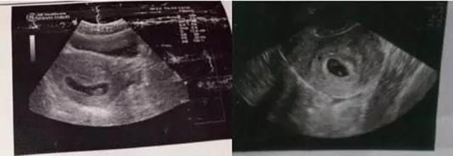这位准爸爸都相信的孕囊形状看男女方法,真的靠谱儿吗?